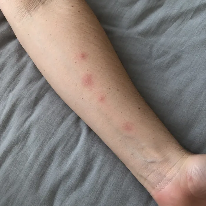 Petits boutons rouges de piqûres de punaises de lit alignés sur un avant-bras